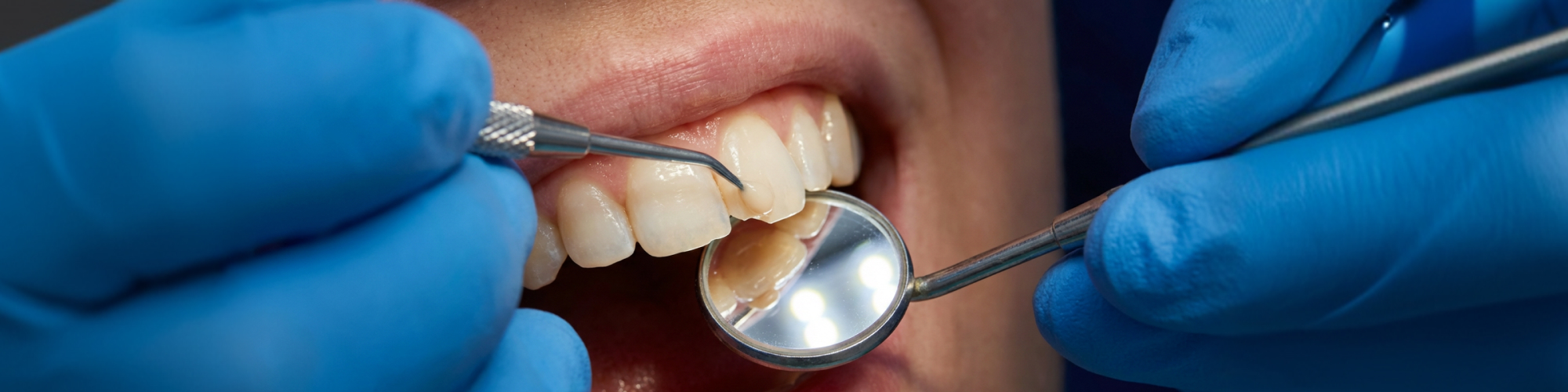Gloved hand applying composite to a chipped front tooth.